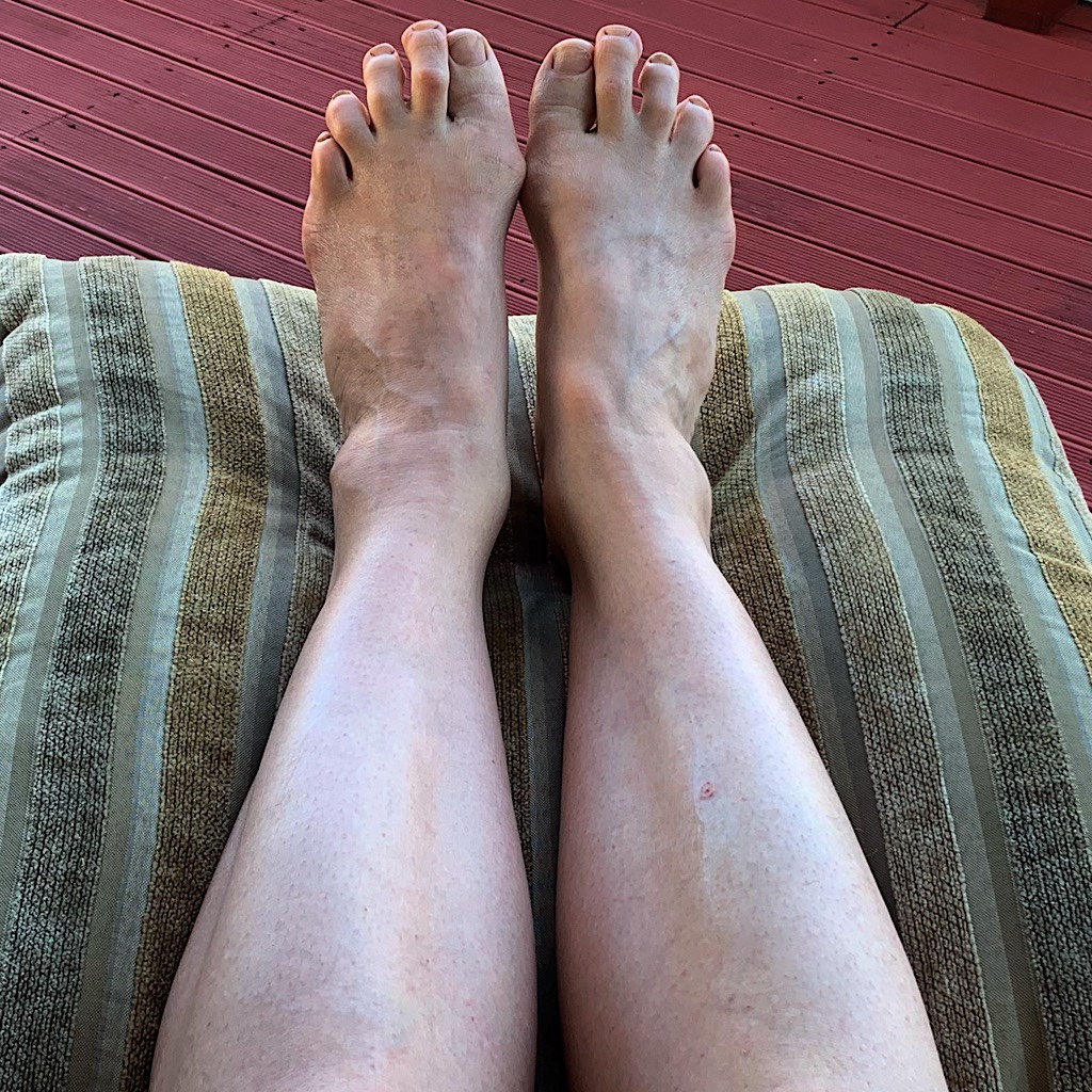 These arthritic and deformed feet are carrying my body really far. The legs got their first hair-removal in two months.